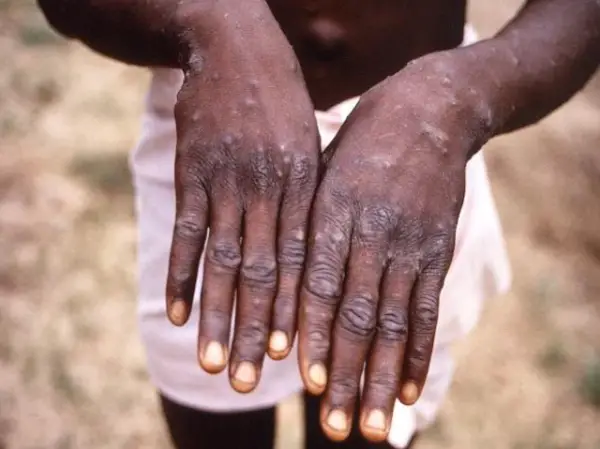 Monkeypox: Canada confirms 890 cases, Ontario has the highest number